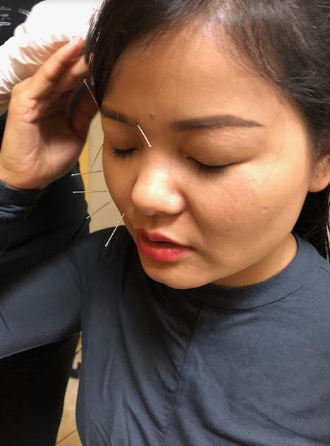 Acupuncture in East Vancouver