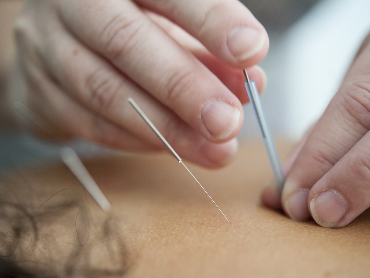Acupuncture needles being placed along a client's back